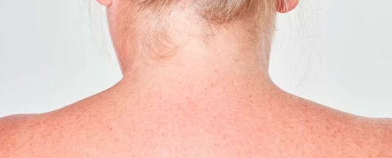 Manchas En El Cuello Causas Tratamientos Y Prevenci N Blog Druni